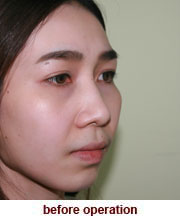 plastic_surgery_augmentation_rhinoplasty